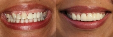 Crown and Bridge Case 1 Smiling: Before & After