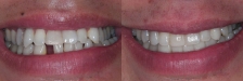 Crown and Bridge Case 2 Smiling: Before & After