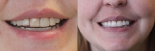 Crown and Bridge Case 3 Smiling: Before & After