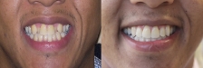 Invisalign Case 1: Before & After