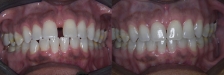 Invisalign Case 2: Before & After