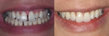 Invisalign Case 3: Before & After