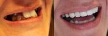 Smile Makeover 1: Before & After