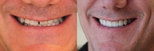 Smile Makeover 2: Before & After