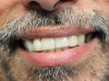 Smile Makeover Implants and Crowns of the Two Central Incis
