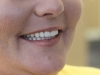 Smile Makeover Upper and Lower Full Dentures