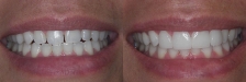 Veneer Case 1: Before & After