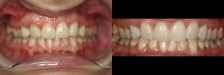 Veneer Case 2 Natural Retracted: Before & After