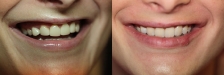 Veneer Case 2 Natural Smile: Before & Afte