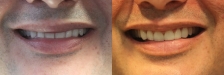 Veneer Case 3: Before & After