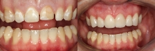 Veneer Case 4 Retracted: Before & After