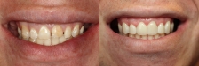 Veneer Case 4: Before & After