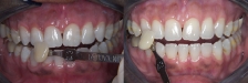 Whitening Case 1: Before & After