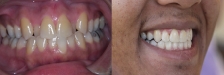 Whitening Case 2: Before & After