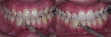 Whitening Case 3: Before & After